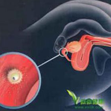 What is in vitro fertilization? Good news for infertile couples!