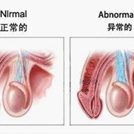 What is varicocele? How to treat it?