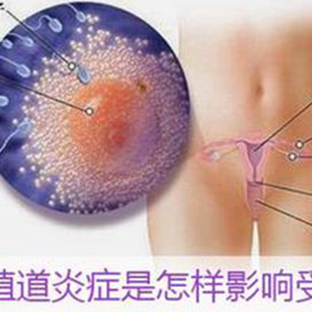 How to treat infertility caused by inflammation of the female reproductive tract?