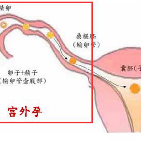 If you have experienced ectopic pregnancy, how should you prepare for pregnancy?