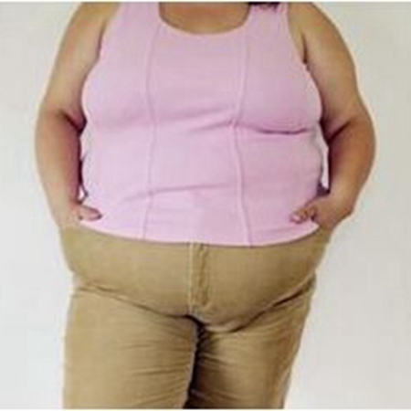 Obesity = good fertility and prone to polycystic ovary syndrome