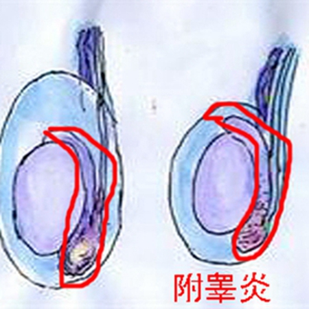 What is epididymitis? How to treat epididymitis?