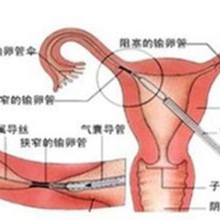 When doing fallopian tube drainage, it is important to grasp the timing