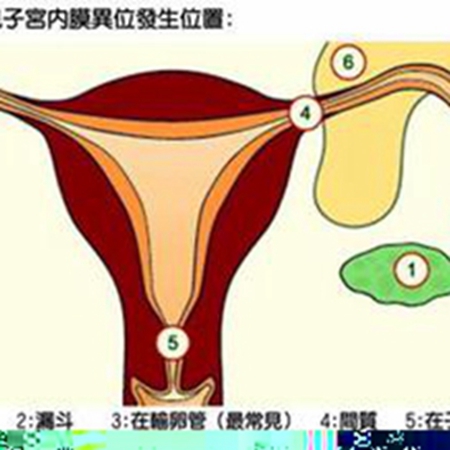 Can endometriosis cause infertility in women?