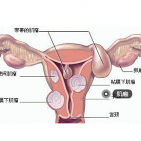 If you have uterine fibroids, you don’t necessarily have to have them removed.