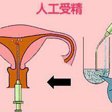 What are the indications for artificial insemination? What situations does it adapt to?