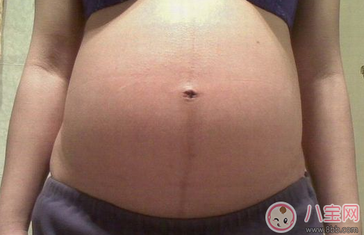 How to use stretch marks to determine whether you are pregnant with a boy or a girl? How to determine gender via stretch marks