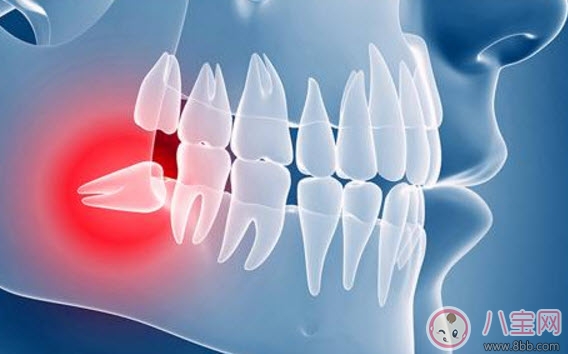  Will wisdom teeth definitely become inflamed during pregnancy? Do wisdom teeth have to be extracted?