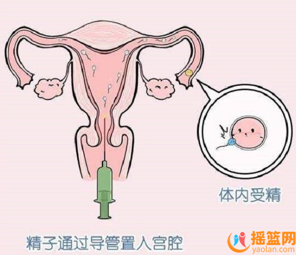 Artificial insemination cannot determine whether the child will be a boy or a girl.