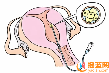 When is the most appropriate time to perform intrauterine infusion during pregnancy preparation? Precautions after intrauterine infusion