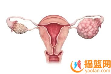 How to recognize the early signs of ovarian cancer? Which women are more at risk from ovarian cancer?